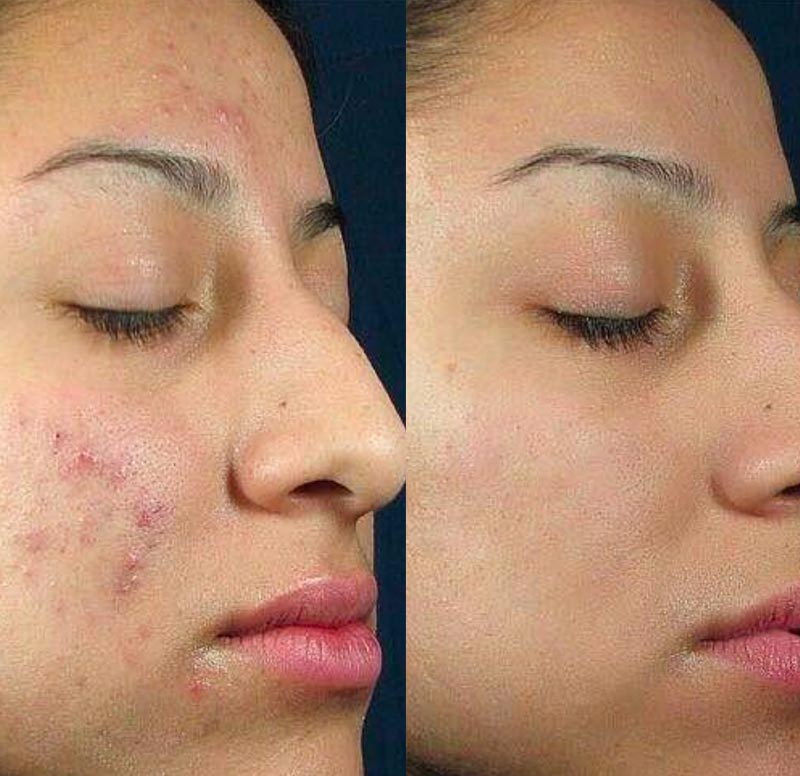 acne acne